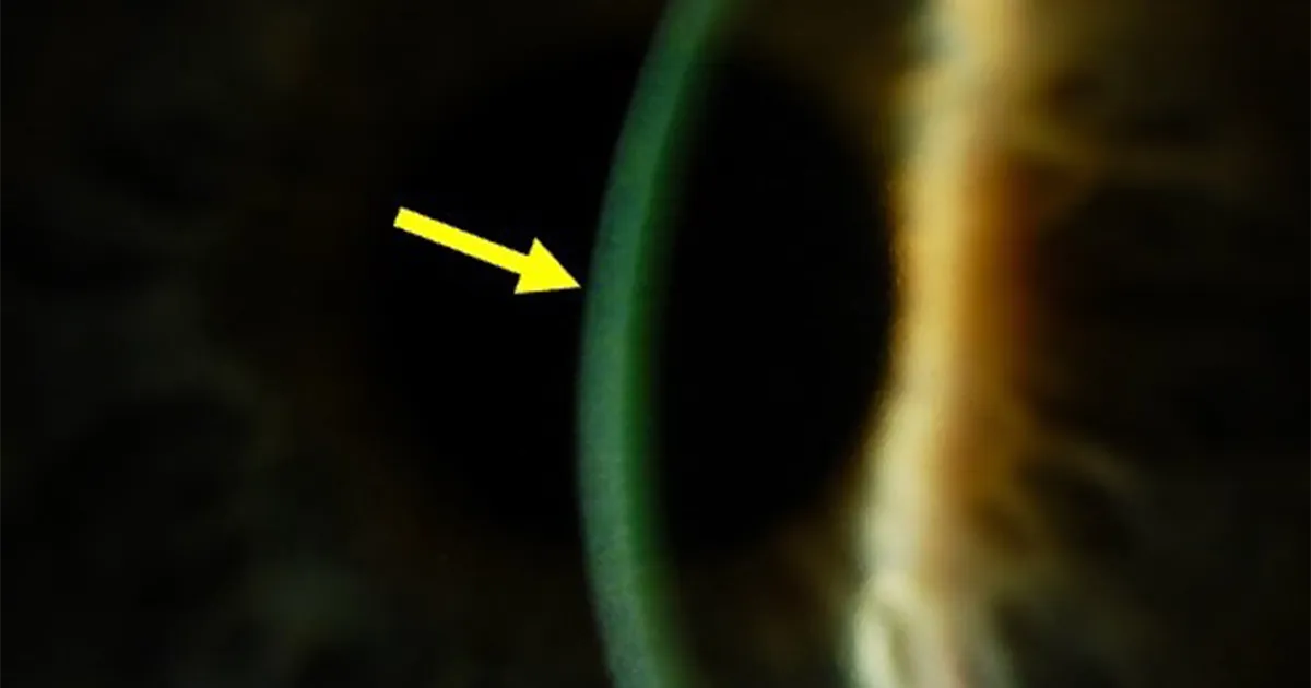 Riboflavin in the cornea